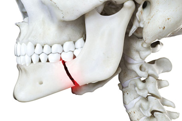 FACIAL-TRAUMA